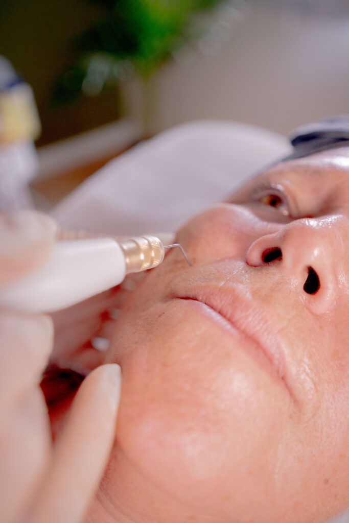 Soin au plasma : gros plan de l'embout appliqué avec précision près du visage d'une cliente